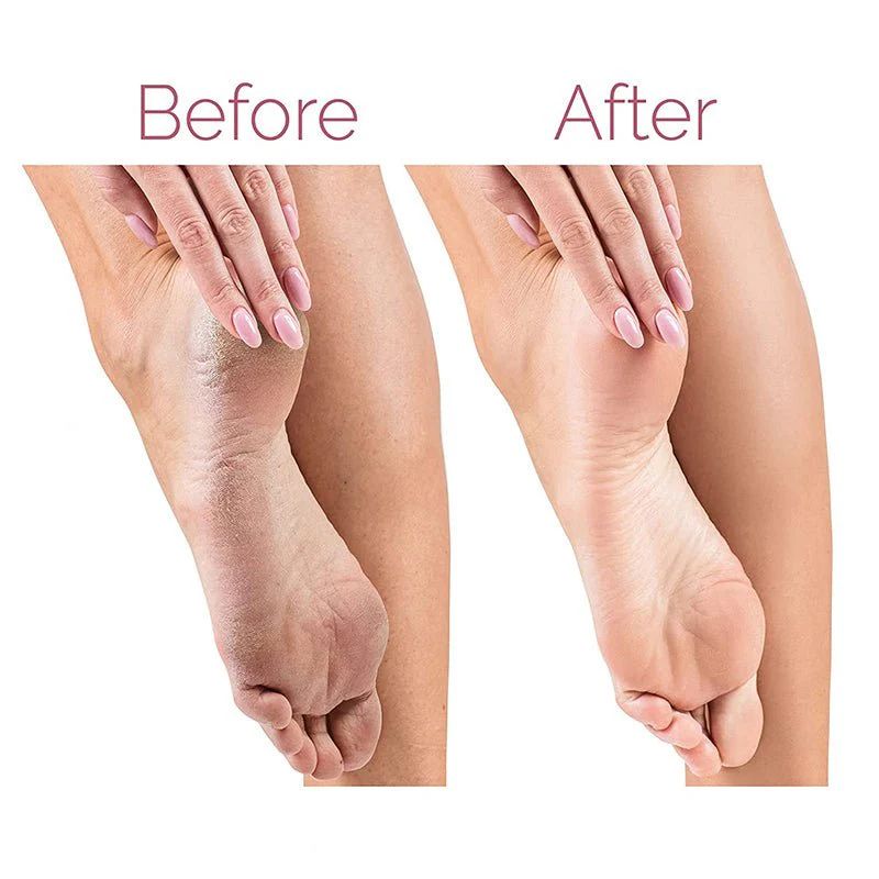 Electric Pedicure Foot File – Rechargeable Callus Remover